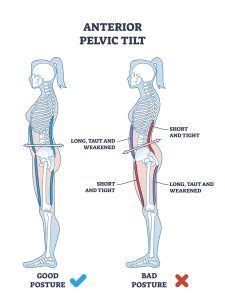 How To Fix Anterior Pelvic Tilt Posture - Chatfield Family & Sports ...