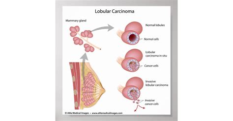 Lobular breast cancer, labeled diagram. poster | Zazzle