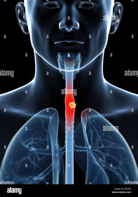 3d rendered illustration of esophagus cancer Stock Photo - Alamy