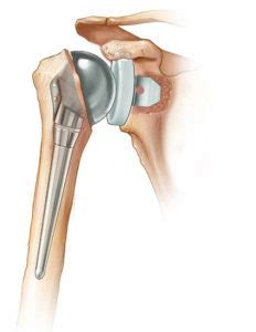 Total Shoulder Replacement Outcomes Cleveland Shoulder Institute