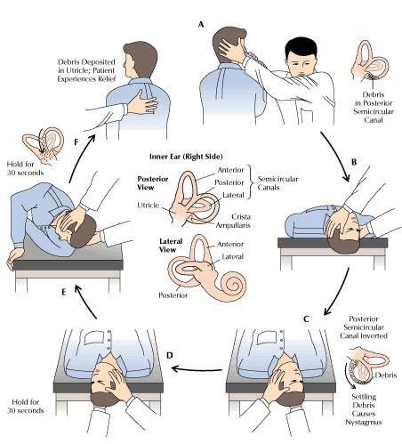 vestibular rehabilitation exercises - Yahoo Image Search Results ...