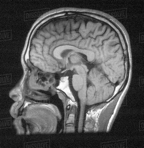 MRI of head showing normal brain structures - Stock Photo - Dissolve