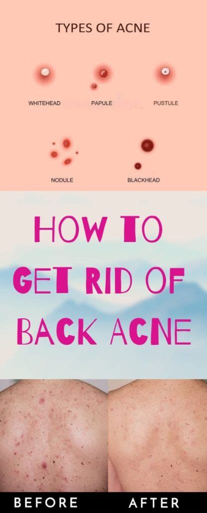 Pin by Christine Hannible on Skin care | Back acne treatment, Chest acne, Diy acne treatment