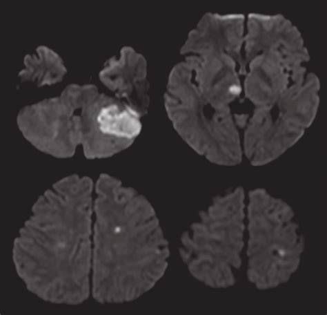 Cephalic MRI-DWI on admission. A high signal intensity involving an ...