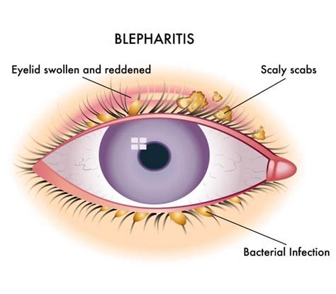 Patient Zone: Blepharitis Explained