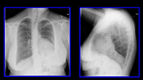 PHRENIC NERVE INJURY CAUSING DIAPHRAGM EVENTRATION XRAY #patientsafety #FOAMRAD - YouTube