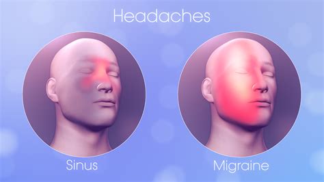 Your Sinus Headache Could Be Migraine - Scientific Animations