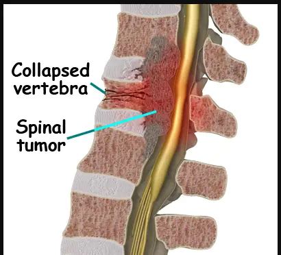 Different Types of Spinal Cancer You Didn't Know - Body Pain Tips