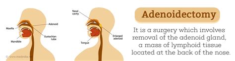 Adenoidectomy - Indications, Preparation, Procedure & Complications