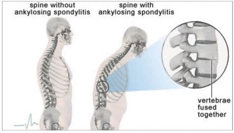 Ankylosing Spondylitis