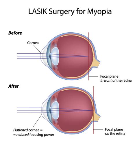 LASIK Eye Surgery for Vision Correction at Fort Worth Eye Associates