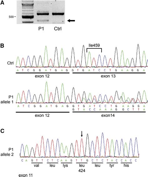 The Splice-Site Mutation in Proband 1 Results in Skipping of Exon 13 ...