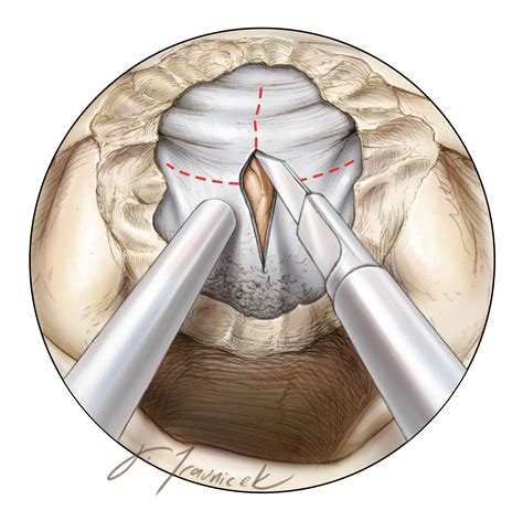 Tuberculum Sellae