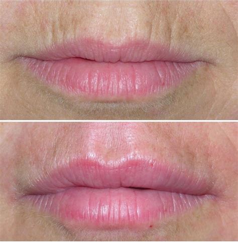 HOW TO GET RID OF WRINKLES ABOVE YOUR LIPS ? | The London Facial Care
