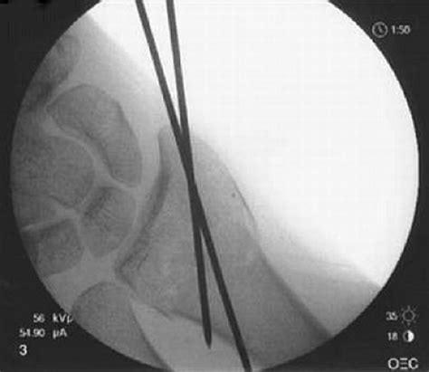 Closed Reduction and Percutaneous Pinning | Musculoskeletal Key