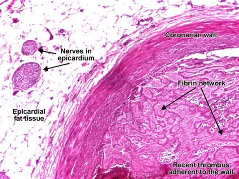 موقع الدكتور أحمد كلحى: صور باثولوجى - ﻿Patholgy Slides : Cardiovascular pathology