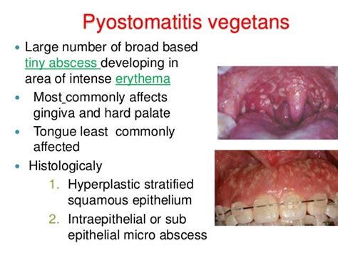 dental consideration for inflammatory bowel disease