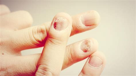 Nail Psoriasis vs. Fungus: What’s the Difference? - TheWellthieone