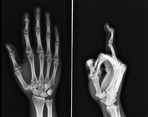 Swan Neck Deformity - Hand - Orthobullets