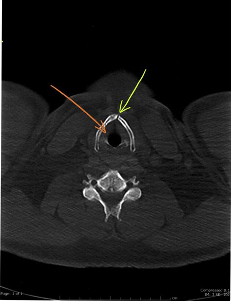 Laryngeal Fracture After a Stifled Sneeze: A Case Report - Journal of Emergency Medicine