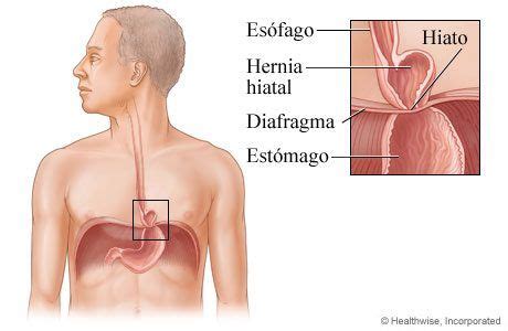 Hernia de Hiato | Causas, sintomas, tratamiento y dieta