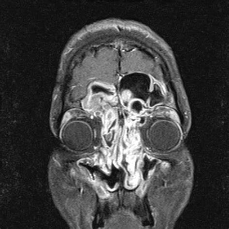 Allergic Fungal Sinusitis - Causes, Symptoms, and Treatment