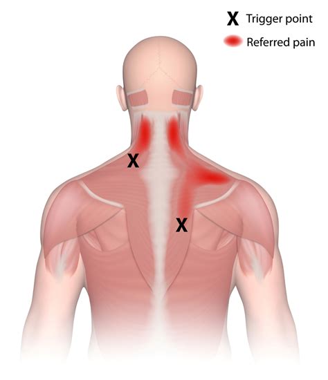 Trigger Point Injections in Sinking Spring & Reading, PA | Smith Chiropractic & Wellness Center