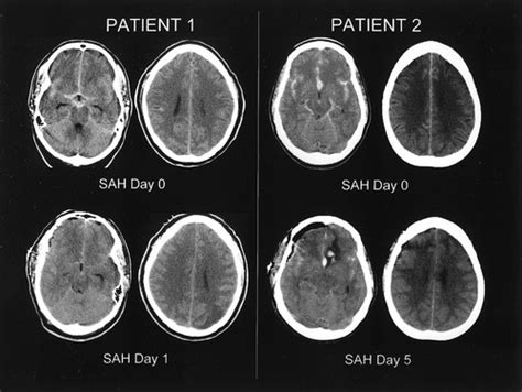 Global Cerebral Edema After Subarachnoid Hemorrhage | Stroke