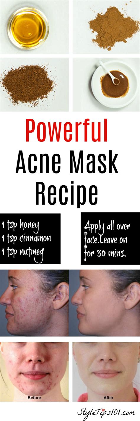 Best 23 Diy Face Masks Acne – Home, Family, Style and Art Ideas