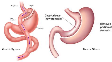 Sleeve Gastrectomy Versus Roux En Y Gastric Bypass A Retrospective | My XXX Hot Girl