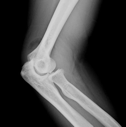 Posterior fat pad sign (elbow) | Radiology Reference Article ...