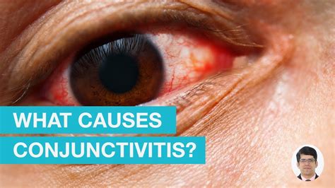 What Causes Conjunctivitis? - YouTube