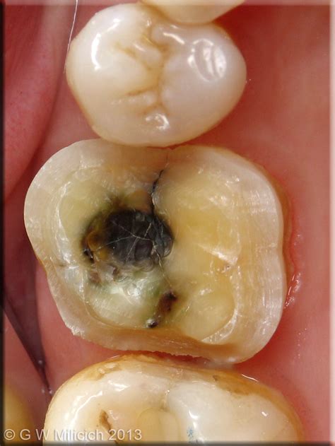 The Six Fracture Modes of Teeth - Graeme Milicich - The British Dental ...