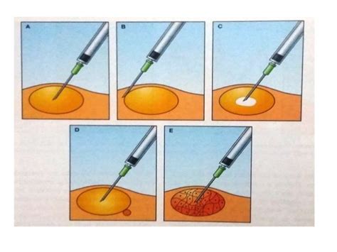 FINE NEEDLE ASPIRATION CYTOLOGY / FNAC