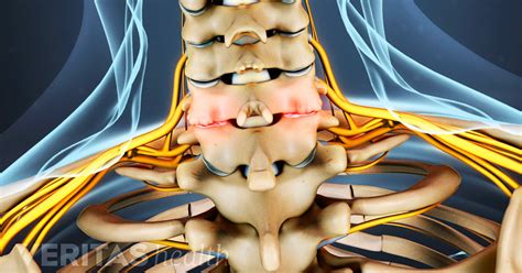 Cervical Osteophytes: Bone Spurs in the Neck