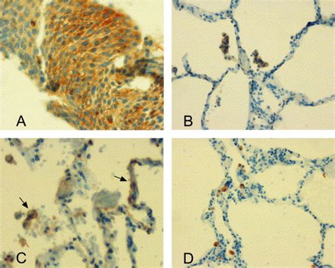 Nitric oxide synthases are associated with bronchial dysplasia - Lung ...