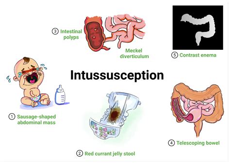 Children | Free Full-Text | Intussusception and COVID-19 in Children: A Systematic Review and ...