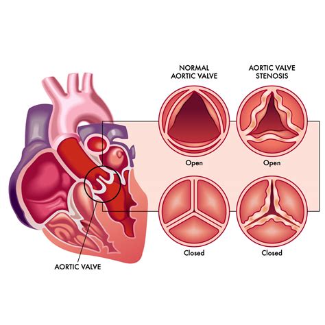 Atrioventricular Valve