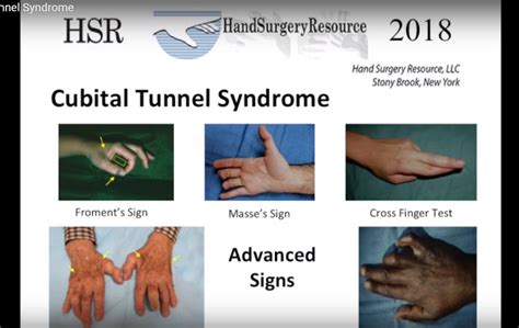 Cubital Tunnel Syndrome — OrthopaedicPrinciples.com