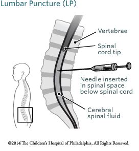 Lumbar Puncture | Children's Hospital of Philadelphia