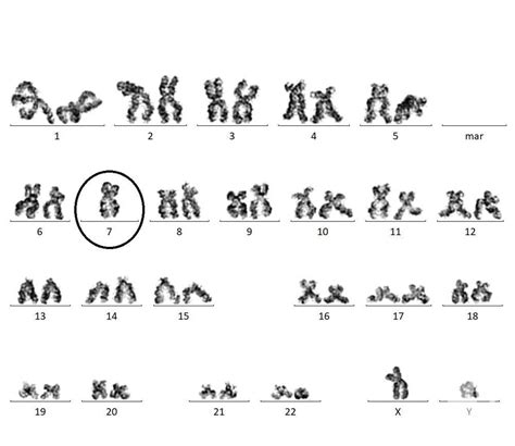 CMML-1 with monosomy 7 by karyotyping