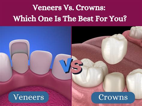 Veneers Vs. Crowns: Which One Is The Best For You?