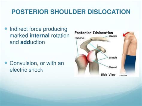 PPT - Acute Joint Dislocation PowerPoint Presentation, free download ...