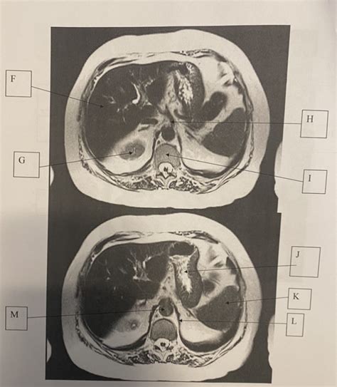 MRI Abdomen Anatomy 2 Diagram | Quizlet