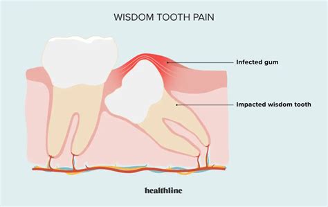 How To Treat Swollen Gums Near Wisdom Tooth Home Remedies