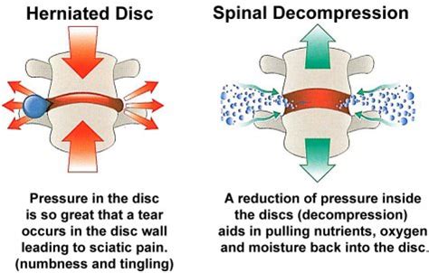 What is spinal decompression and how it could help - Plano Chiropractor ...