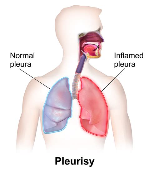 Pleurisy Is The Pain Of hitting With a sharp Knife | Causes - Health ...