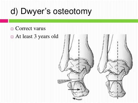 Mellss yr5 ortho treatment of congenital talipes equino varus (ctev)