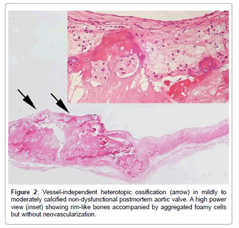 Aortic Valve Histology