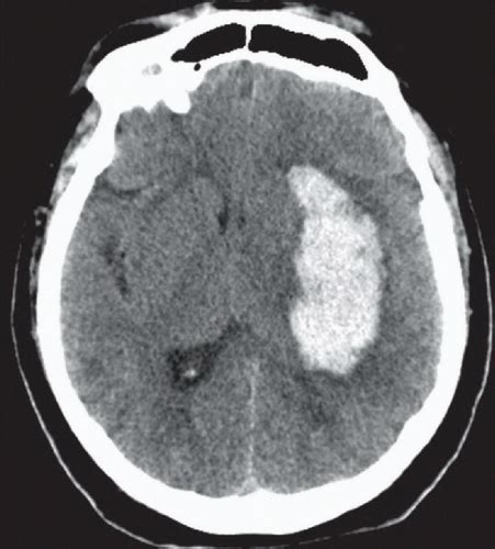 Hypertensive Basal Ganglia Hemorrhage | Radiology Key